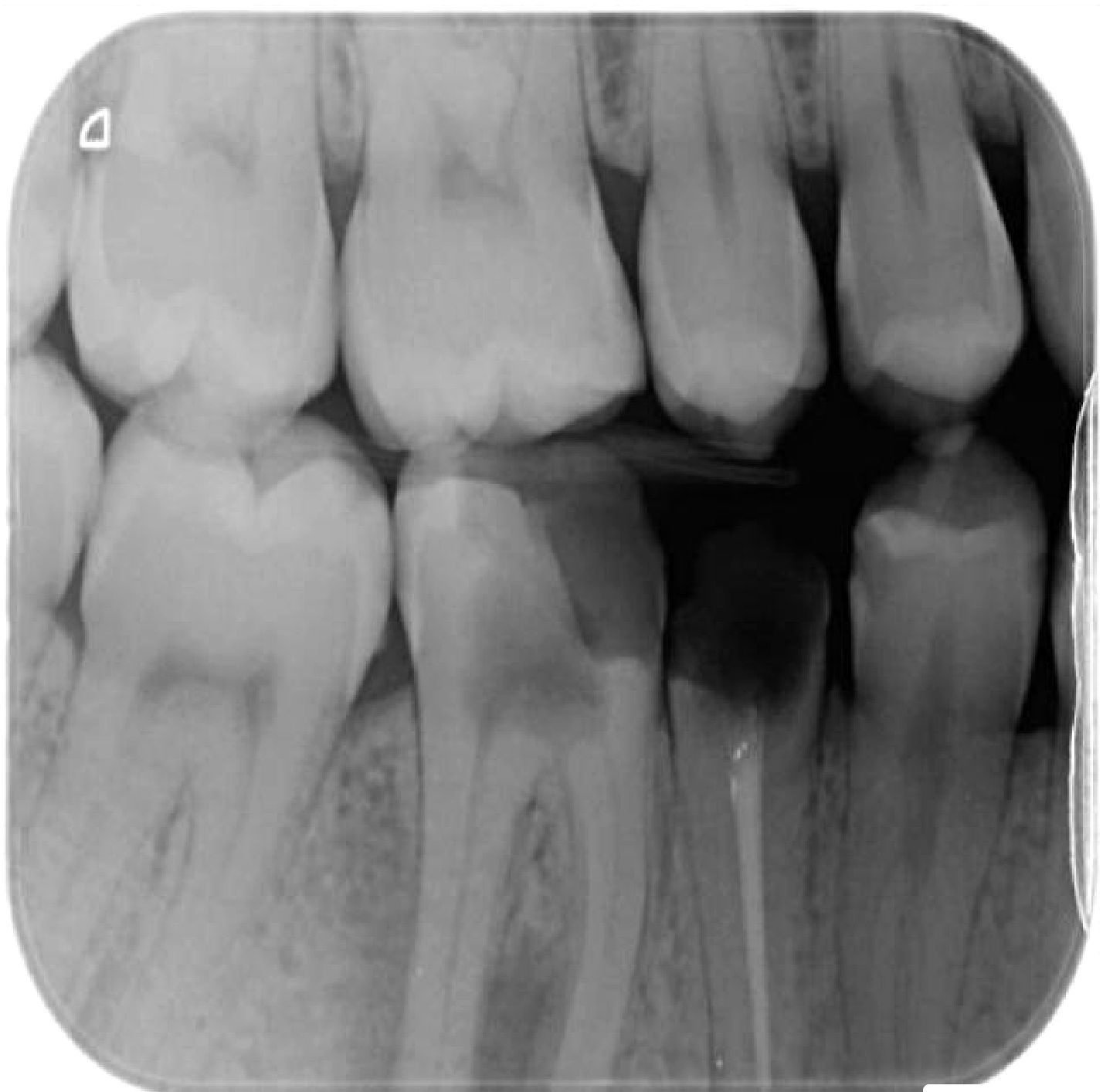 Original Dental X-ray